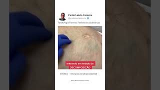 TANATOLOGIA FORENSE  MEDICINA LEGAL  PROF LAÉCIO [upl. by Kain111]