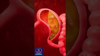 Gastroesophageal reflux disease  GERD Short Explanation [upl. by Stillas231]