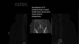 Sacralization of L5 vertebral body is noted spinesurgeon neurosurgeon orthopedicsurgeon [upl. by Indira]