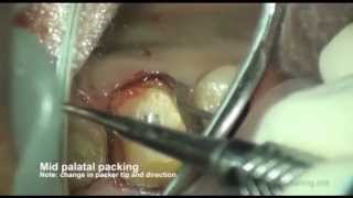 Gingival Retraction methods [upl. by Dorweiler]