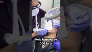 Mole Removal by CO2 Laser [upl. by Cirdnek635]