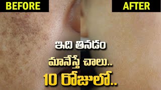 Permanent Soloution For Pigmentation in Telugu  Homemade remedies  Natural Cure for Pigmentation [upl. by Ymmij446]