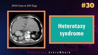 Heterotaxy Syndrome Radiology Tutorial  1000 cases in 100 Days  Video 30 [upl. by Nynahs]