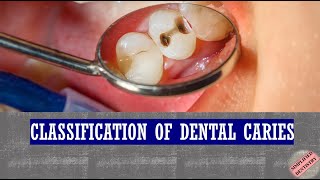 Classification of Dental Caries [upl. by Wilona]