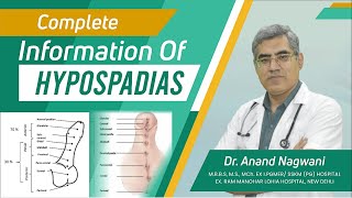 Complete Information about Hypospadias in Kolkata Hindi  वयस्क अधोमूत्रमार्गता  Dr Nagwani [upl. by Norret939]