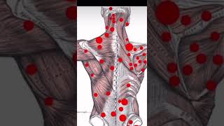 Trigger point therapy  Saara physio [upl. by Stevena385]