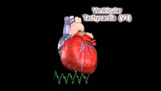 Ventricular Tachycardia VT [upl. by Wadsworth]