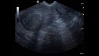 Myoma Uteri Ultrasound 12 [upl. by Ahon695]