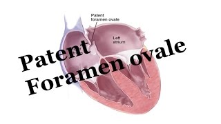 Whats Patent Foramen Ovale PFO Pediatrics [upl. by Atneciv]