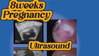 8 weeks Pregnancy  Early Pregnancy  Alive Fetus  Anomaly Scan  Normal Obs Ultrasound [upl. by Nydnarb]