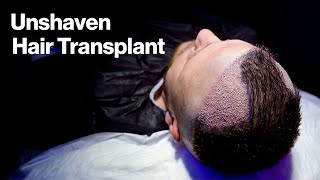 Unshaven Hair Transplant  Must watch [upl. by Siusan785]