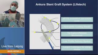 LINC 2017 Lifetech Ankura TEVAR live case with Dr Andrej Schmidt [upl. by Olracnaig]