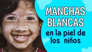 Manchas blancas en la piel de los niños ¿Cómo diferenciarlas [upl. by Nessnaj]