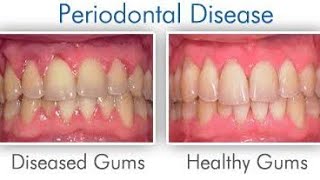 quotSaveYourSmile Understanding Periodontitis and Howto Prevent Itquotgumdisease oralhealthdentist [upl. by Dwinnell]