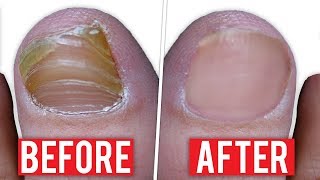 Fingernail fungus treatment  Best Natural Remedy For Fingernail Fungus [upl. by Airreis]