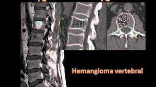 Hemangioma vertebral [upl. by Learrsi344]