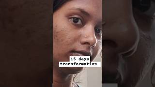 💯15 ദിവസം കൊണ്ട് എൻ്റെ skin ൽ Change കൊണ്ടു വന്ന facepack skintransformation acnejourney viral [upl. by Ahnavas]