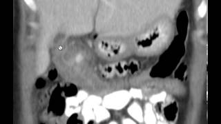 CT Abdomen Diverticulitis Discussion by Radiologist [upl. by Terrena534]