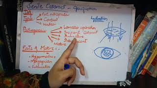 SENILE CATARACT very IMPORTANT topic ade simple part 1 [upl. by Nnahgaem537]