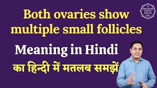 Both ovaries show multiple small follicles meaning in Hindi  English to hindi [upl. by Helbonia]