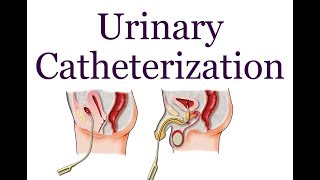 Urinary Catheterization  Hindi [upl. by Thaddaus898]