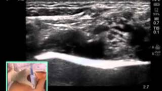 UltrasoundGuided Supraclavicular Brachial Plexus Nerve Block  SonoSitemp4 [upl. by Obeng]