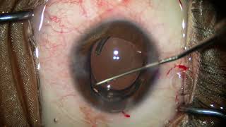 Case of Traumatic cataract with ZD with Traumatic Mydriasis managed with Phaco with pupilloplasty [upl. by Zullo427]