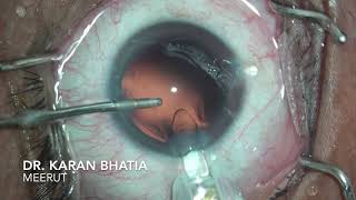 Cataract surgery Phacoemulsification with HOYA Vivinex Gemetric Trifocal IOL  Dr Karan Bhatia [upl. by Enahsed181]