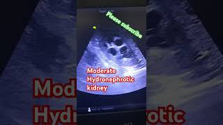 kidney scan hydronephrosis in kidney ultrasound usg kidney hydronephrosis [upl. by Mackintosh752]