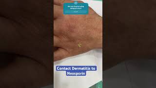 Neosporin Allergy Expert dermatologist reveals the Truth drashimagoel dermatologistinpunjab [upl. by Dalli]