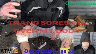 “My Tranq Sores Had Maggots”  David Interview [upl. by Thilda99]